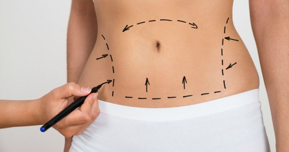 Abdominoplasty (Tummy Tuck)